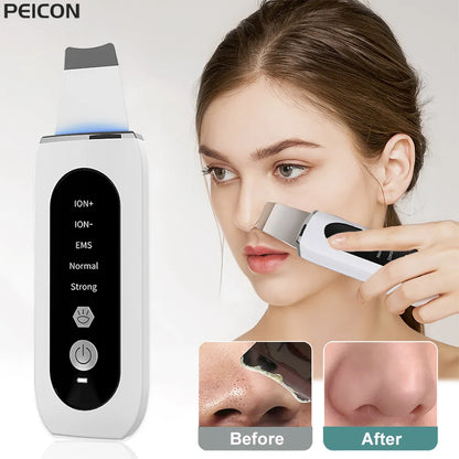 Ultrasonic Blackhead Remover